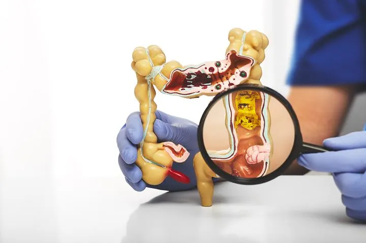 IBS vs IBD — understanding the difference